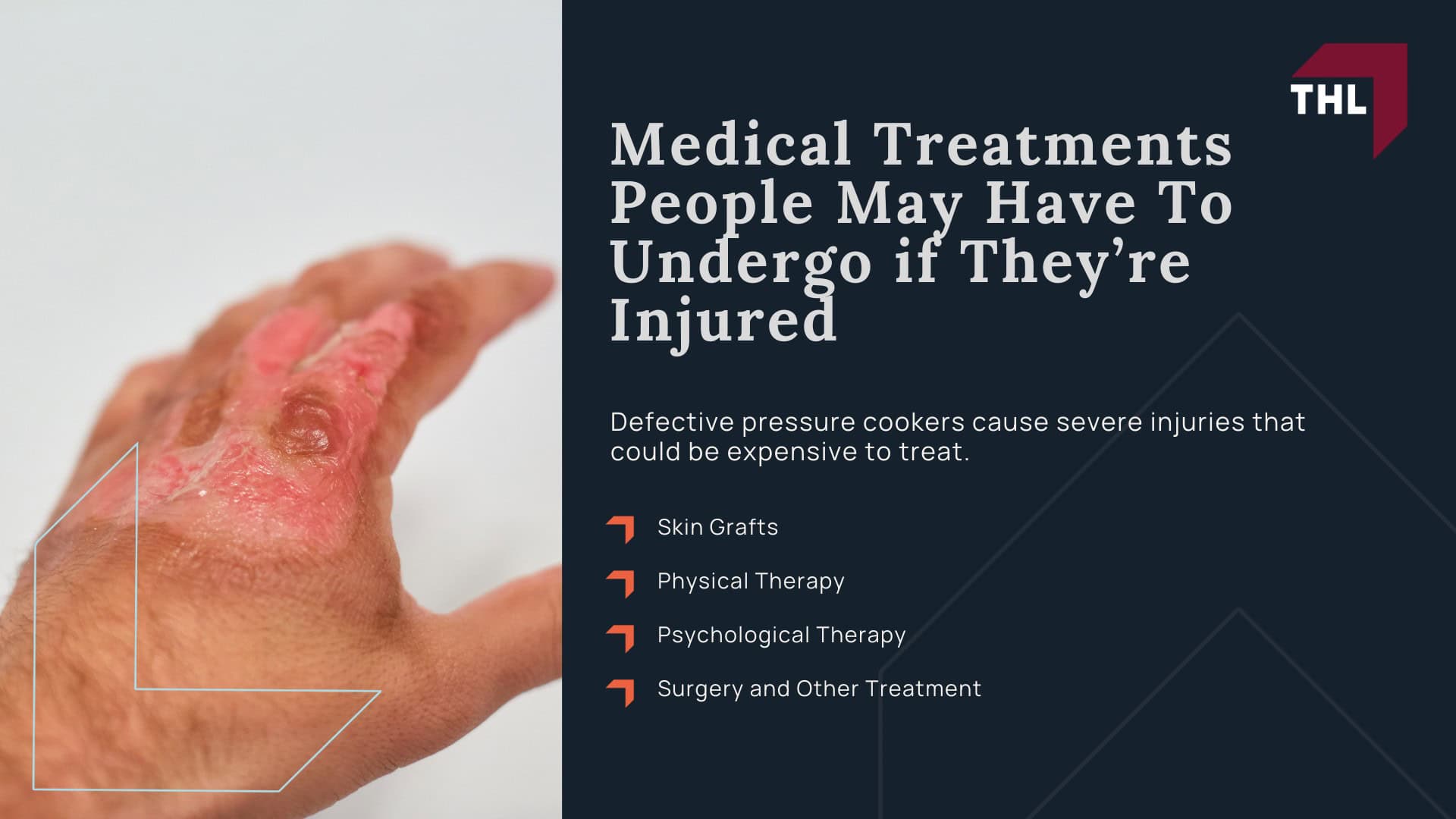 _Pressure Cooker Exploded The #1 Pressure Cooker Lawyers Can Help - Everything You Need To Know About Pressure Cooker Explosions; _Pressure Cooker Exploded The #1 Pressure Cooker Lawyers Can Help - Pressure Cooker Explosions in the News; _Pressure Cooker Exploded The #1 Pressure Cooker Lawyers Can Help - Why Do Pressure Cookers Explode; _Pressure Cooker Exploded The #1 Pressure Cooker Lawyers Can Help - Documented Recalls for Defective Pressure Cookers and Instant Pots; _Pressure Cooker Exploded The #1 Pressure Cooker Lawyers Can Help - Most Common Defective Pressure Cooker Injuries; _Pressure Cooker Exploded The #1 Pressure Cooker Lawyers Can Help - Medical Treatments People May Have To Undergo if They’re Injured