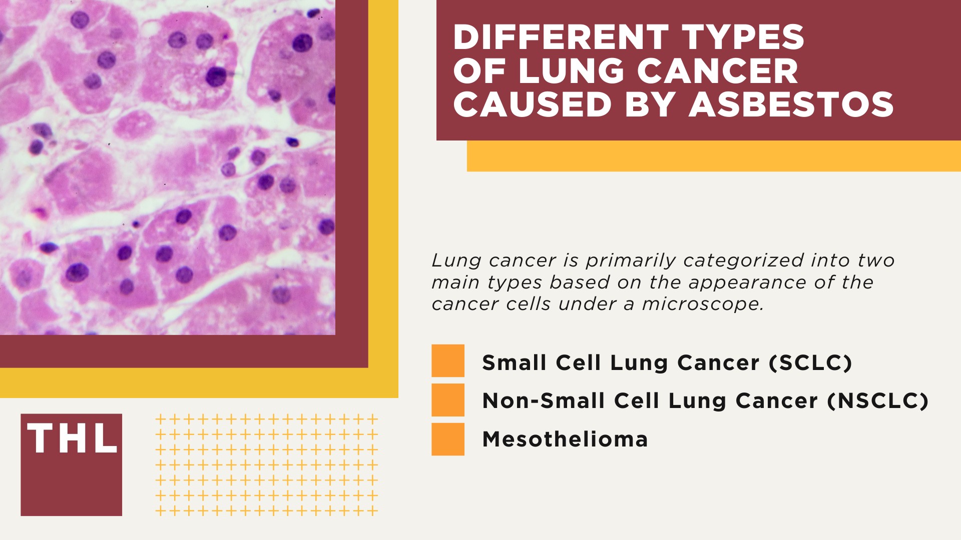 Asbestos Exposure and Lung Cancer; Different Types of Lung Cancer Caused by Asbestos