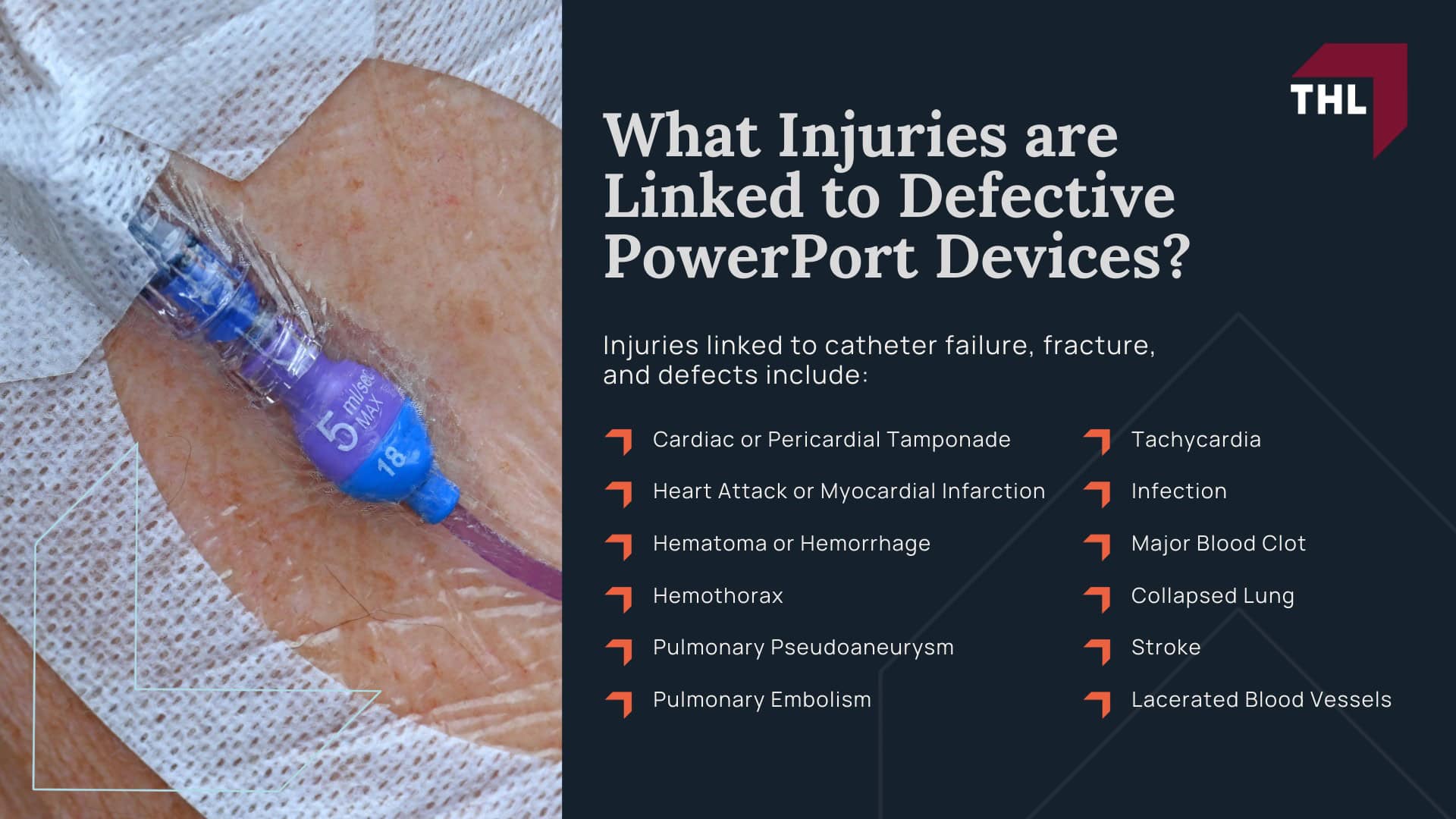 Bard Power Port Lawsuit Settlement Amounts - Projected Bard PowerPort Lawsuit Settlement Amounts - torhoerman law; Bard Power Port Lawsuit Settlement Amounts - Tier 2 Major Complications with Lasting Health Impact ($75,000 – $200,000) - torhoerman law; Bard Power Port Lawsuit Settlement Amounts - Tier 3 Moderate Injuries and Short-Term Complications ($10,000 – $75,000) - torhoerman law; Bard Power Port Lawsuit Settlement Amounts - Bard Port Catheter Lawsuit Overview - torhoerman law; Bard Power Port Lawsuit Settlement Amounts - Bard PowerPort Lawsuit Allegations - torhoerman law; Bard Power Port Lawsuit Settlement Amounts - What Injuries are Linked to Defective PowerPort Devices - torhoerman law