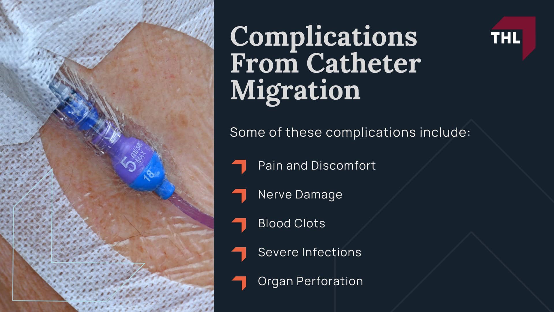 Bard PowerPort Migration Lawsuit - Intro to the Bard PowerPort Migration Lawsuits - torhoerman law; Bard PowerPort Migration Lawsuit - What Is the Bard PowerPort Device_ - torhoerman law; Bard PowerPort Migration Lawsuit - Who Uses Bard PowerPort Devices_ - torhoerman law; Bard PowerPort Migration Lawsuit - Known Complications Associated With Bard PowerPort - torhoerman law Devices; Bard PowerPort Migration Lawsuit - Intro to the Bard PowerPort Migration Lawsuits - torhoerman law; Bard PowerPort Migration Lawsuit - What Is the Bard PowerPort Device_ - torhoerman law; Bard PowerPort Migration Lawsuit - Who Uses Bard PowerPort Devices_ - torhoerman law; Bard PowerPort Migration Lawsuit - Known Complications Associated With Bard PowerPort - torhoerman law Devices; Bard PowerPort Migration Lawsuit - Intro to the Bard PowerPort Migration Lawsuits - torhoerman law; Bard PowerPort Migration Lawsuit - What Is the Bard PowerPort Device_ - torhoerman law; Bard PowerPort Migration Lawsuit - Who Uses Bard PowerPort Devices_ - torhoerman law; Bard PowerPort Migration Lawsuit - Known Complications Associated With Bard PowerPort - torhoerman law Devices; Bard PowerPort Migration Lawsuit - Intro to the Bard PowerPort Migration Lawsuits - torhoerman law; Bard PowerPort Migration Lawsuit - What Is the Bard PowerPort Device_ - torhoerman law; Bard PowerPort Migration Lawsuit - Who Uses Bard PowerPort Devices_ - torhoerman law; Bard PowerPort Migration Lawsuit - Known Complications Associated With Bard PowerPort - torhoerman law Devices; Bard PowerPort Migration Lawsuit - Complications From Catheter Migration - torhoerman law