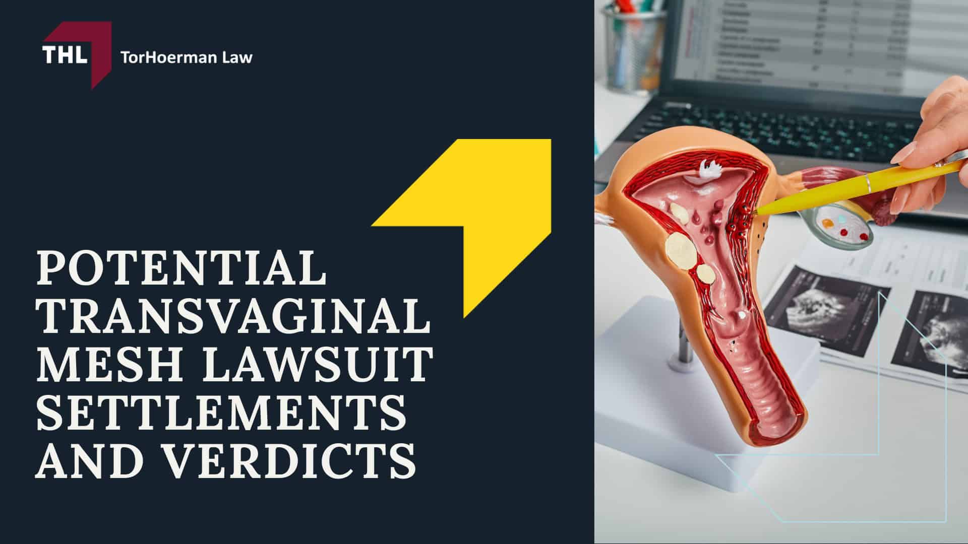 Potential Transvaginal Mesh Lawsuit Settlements and Verdicts; Potential Transvaginal Mesh Lawsuit Settlements and Verdicts; #1 Vaginal Mesh Lawyers for Transvaginal Mesh Injuries - Potential Transvaginal Mesh Lawsuit Settlements and Verdicts
