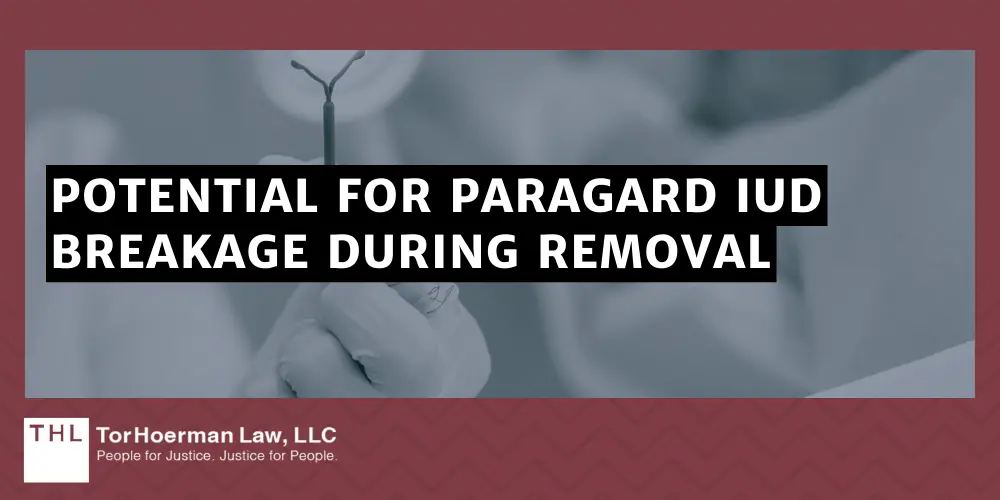 Can I File a Lawsuit if My IUD Broke During Removal; IUD Broke During Removal; Paragard Lawsuit; Paragard IUD Lawsuits; Paragard IUD Lawsuit; Overview Of The Paragard IUD And Potential Complications; Potential For Paragard IUD Breakage During Removal