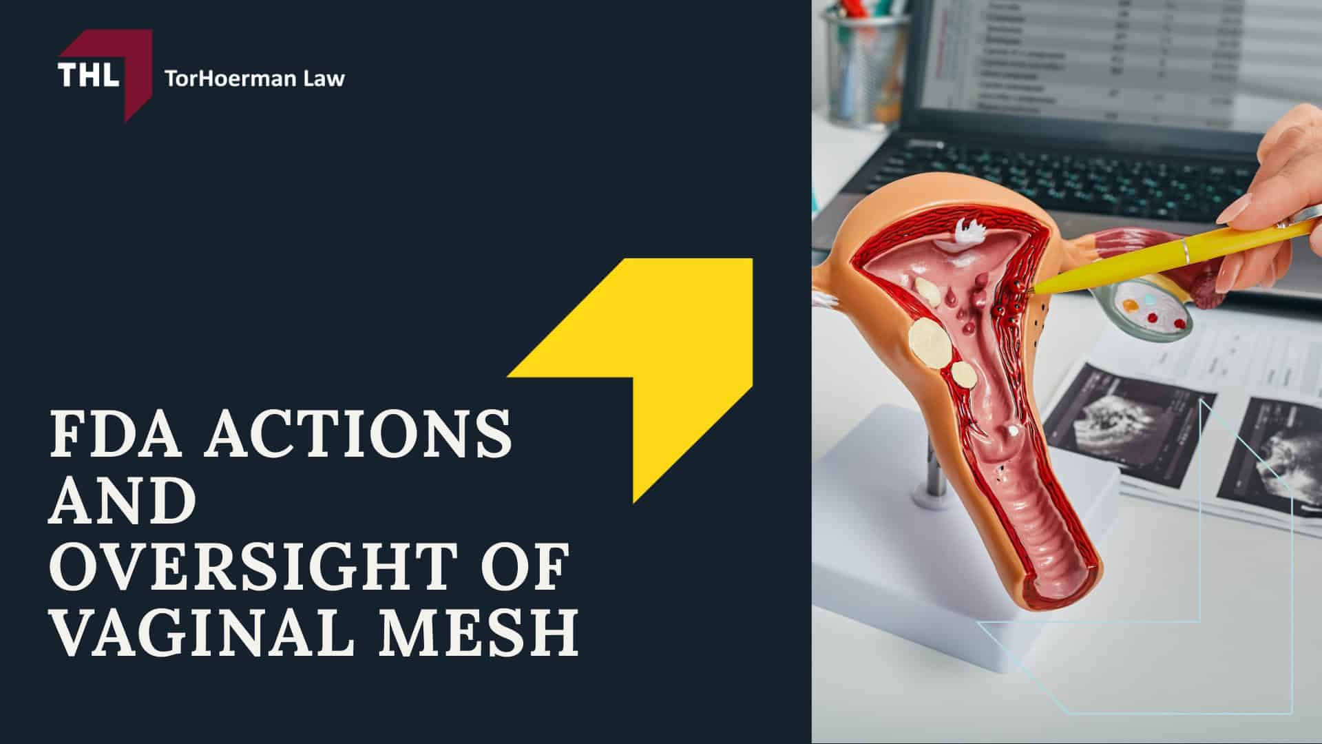 Ethicon Transvaginal Mesh Lawsuit - Ethicon Transvaginal Mesh Lawsuit Overview - torhoerman law; Ethicon Transvaginal Mesh Lawsuit - Ethicon Vaginal Mesh Products Named in Lawsuits - torhoerman law; Ethicon Transvaginal Mesh Lawsuit - How are Vaginal Mesh Injuries and Complications Typically Treated_ - torhoerman law; Ethicon Transvaginal Mesh Lawsuit - FDA Actions and Oversight of Vaginal Mesh - torhoerman law