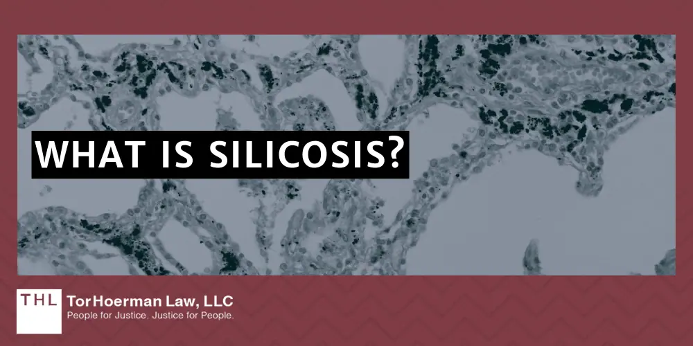 Silicosis Lawsuit; Silica Dust Exposure; Silica Exposure Lawsuit; Silica Lawsuit; Silicosis Lawsuit Overview; What Is The Average Silicosis Lawsuit Settlement Amount; Who Are Silicosis Lawsuits Filed Against;  Health Risks Of Silica Exposure; What Is Silicosis