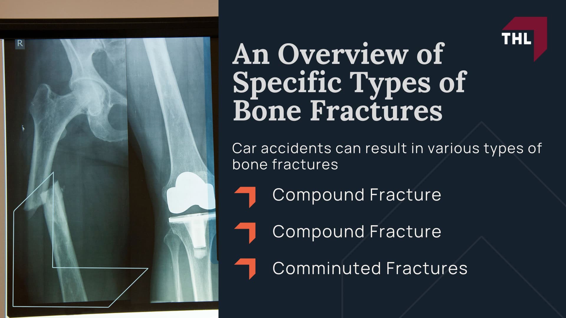 An Overview of Specific Types of Bone Fractures