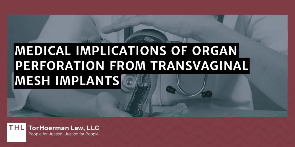 Vaginal Mesh Organ Perforation Lawsuit; vaginal mesh organ perforation; vaginal mesh lawsuit; transvaginal mesh settlement; transvaginal mesh lawsuit; On The Use Of Vaginal Mesh; Vaginal Mesh Organ Perforation; Symptoms Of Organ Perforation; Medical Implications Of Organ Perforation From Transvaginal Mesh Implants