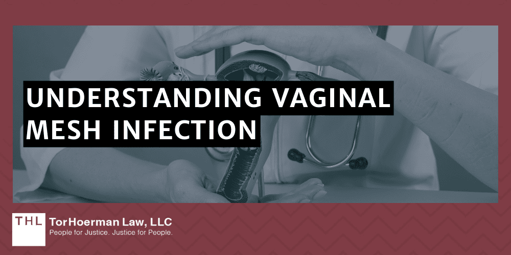 Vaginal Mesh Infection Lawsuit; vaginal mesh infection; transvaginal mesh lawsuit; transavgainal mesh injuries; transvaginal mesh lawyer; vaginal mesh lawsuit; What is Vaginal Mesh; Pelvic Organ Prolapse (POP); Stress Urinary Incontinence (SUI); Understanding Vaginal Mesh Infection