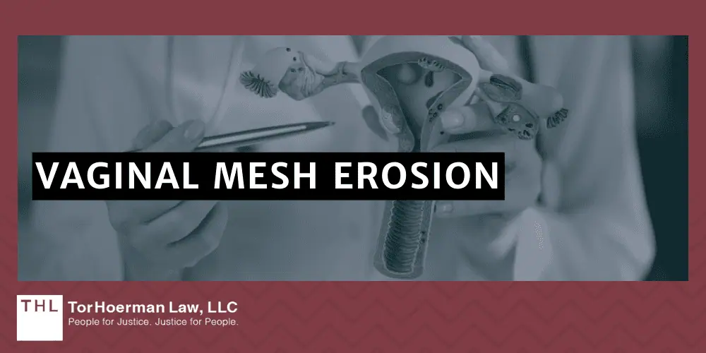 Vaginal Mesh Erosion Lawsuit; vaginal mesh erosion; vaginal mesh lawsuit; transvaginal mesh lawsuit; vaginal mesh complications; vaginal mesh pelvic pain; Vaginal Mesh And Its Uses; Vaginal Mesh Erosion