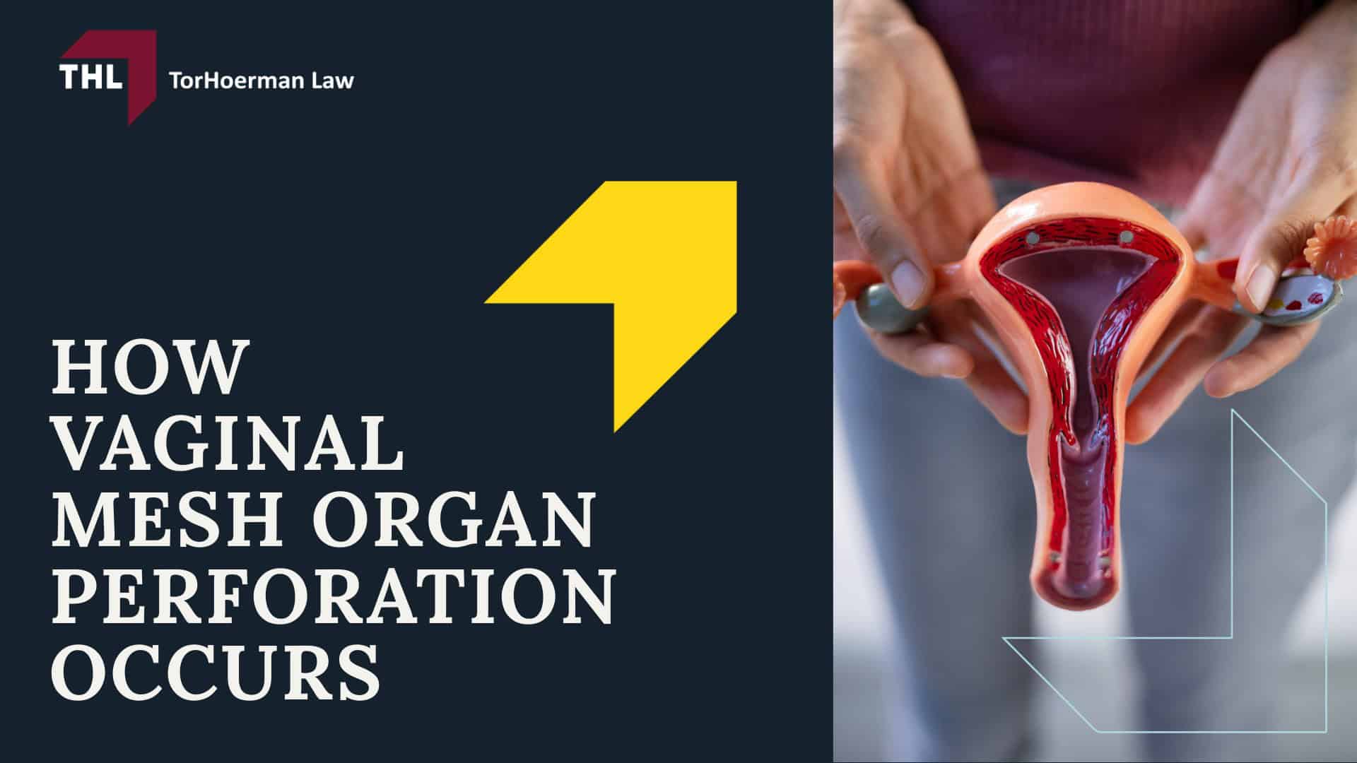 Vaginal Mesh Organ Perforation Lawsuit - On the Use of Vaginal Mesh - torhoerman law; Vaginal Mesh Organ Perforation Lawsuit - What is the Purpose of Transvaginal Mesh - torhoerman law; Vaginal Mesh Organ Perforation Lawsuit - The Applications of Transvaginal Mesh - torhoerman law; Vaginal Mesh Organ Perforation Lawsuit - 2019 Ban by the Food and Drug Administration - torhoerman law; Vaginal Mesh Organ Perforation Lawsuit - Vaginal Mesh Organ Perforation - torhoerman law; Vaginal Mesh Organ Perforation Lawsuit - How Vaginal Mesh Organ Perforation Occurs - torhoerman law