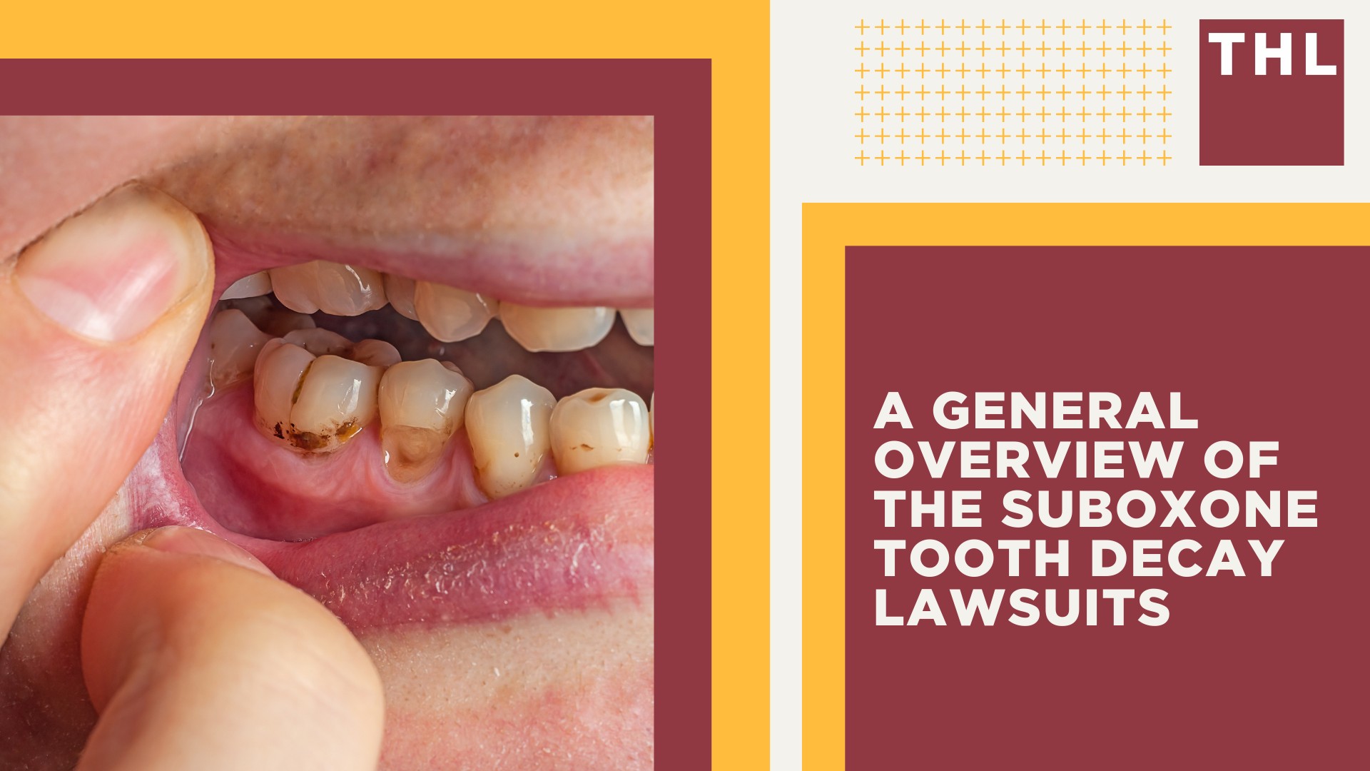 Factors Affecting the Filing of Suboxone Tooth Decay Lawsuits; A General Overview of the Suboxone Tooth Decay Lawsuits