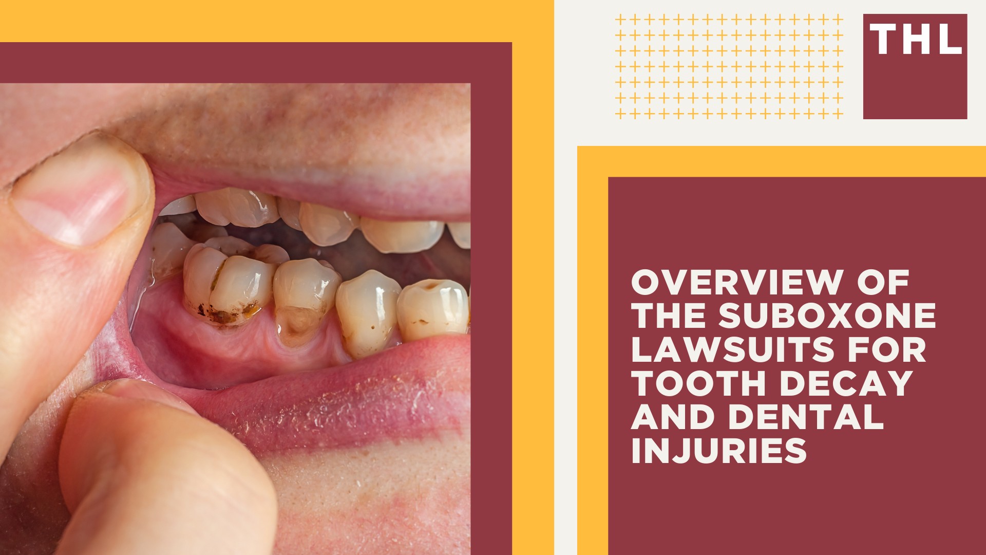 Overview of the Suboxone Lawsuits for Tooth Decay and Dental Injuries