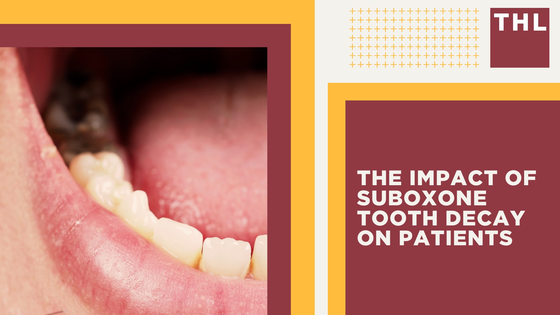 Overview of the Suboxone Lawsuits for Tooth Decay and Dental Injuries; Dental Health Issues Linked to Taking Suboxone; How Does Suboxone Use Cause Severe Tooth Decay; The Impact of Suboxone Tooth Decay on Patients