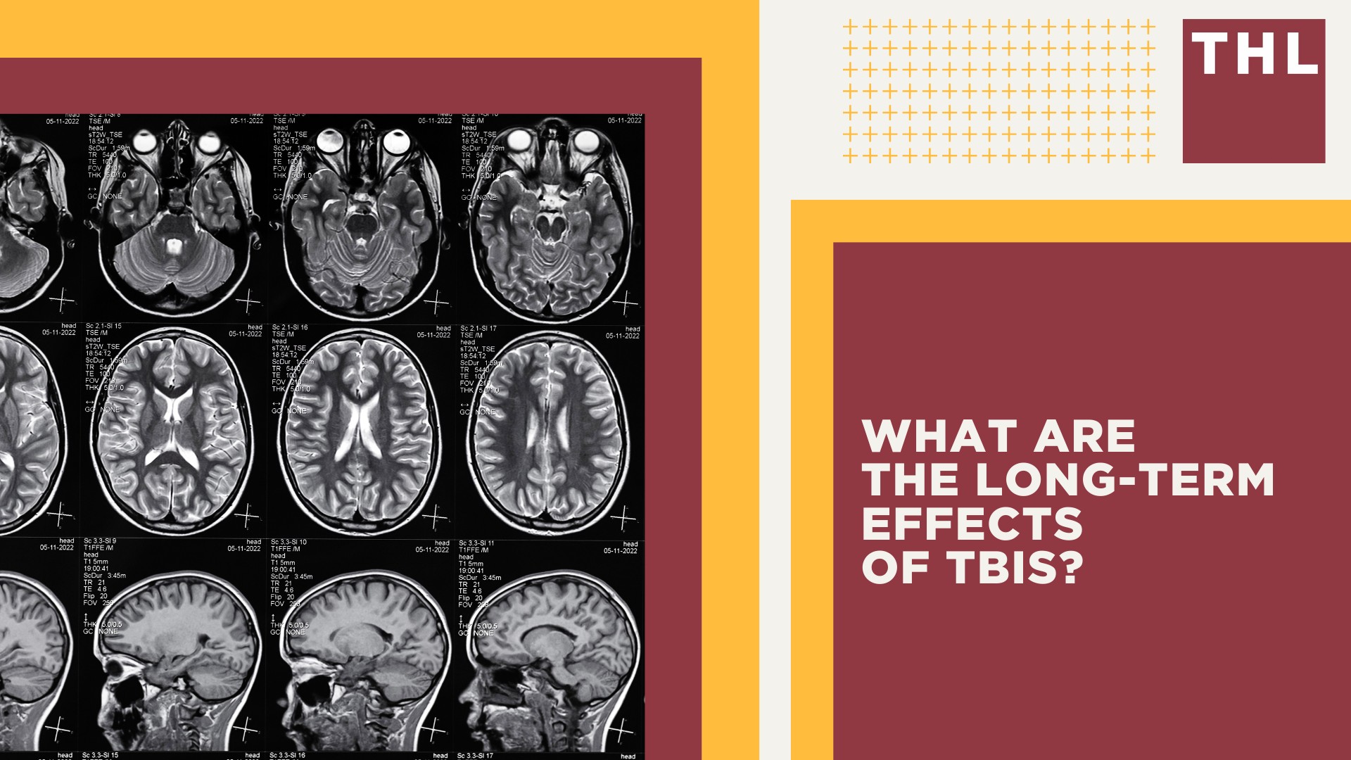 What Are the Long-Term Effects of TBIs