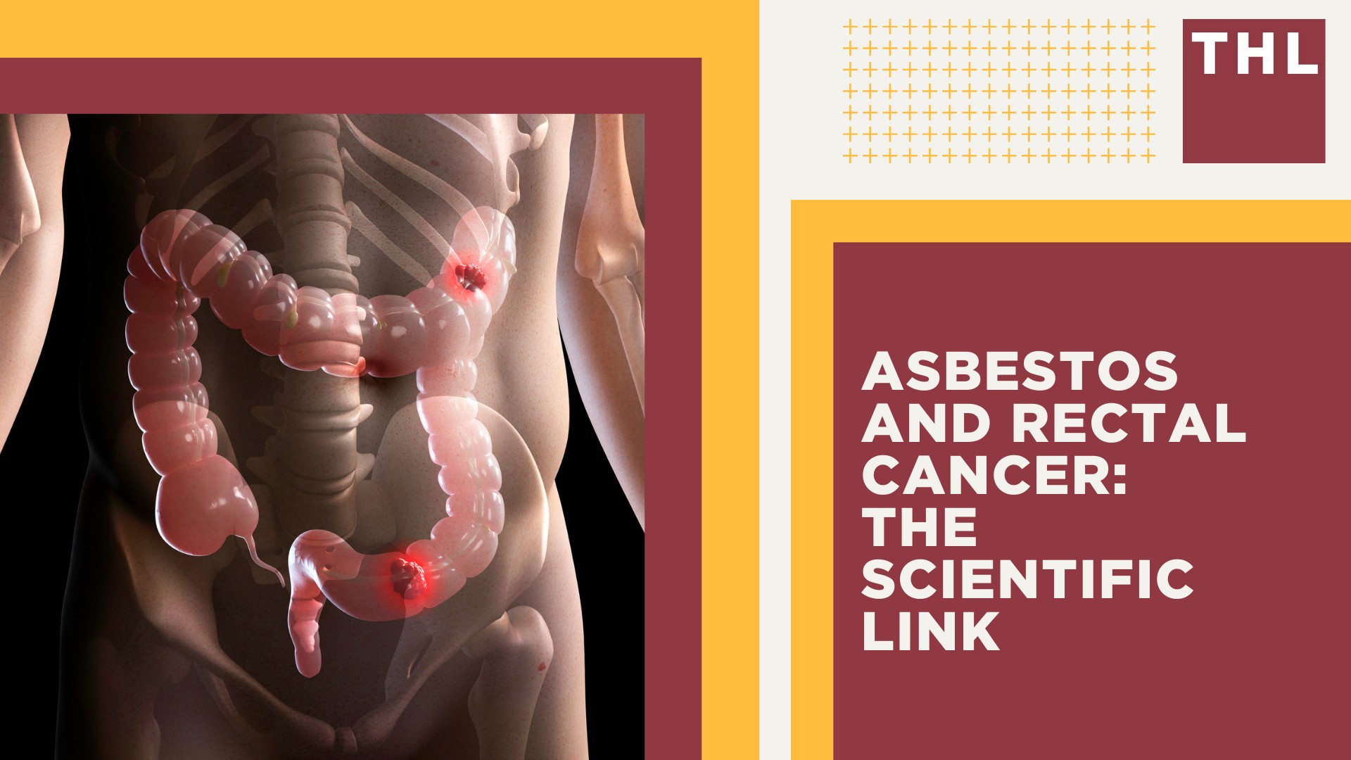 Understanding Asbestos and Exposure; What Is Asbestos; Asbestos and Rectal Cancer_ The Scientific Link