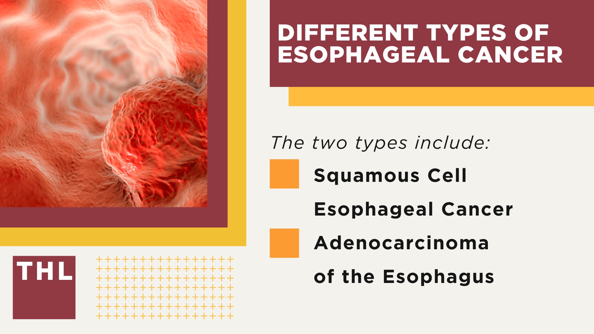 Understanding the Widespread Use of Asbestos; Common Applications of Asbestos; How Does Asbestos Cause Esophageal Cancer; Diagnosing Esophageal Cancer; Different Types of Esophageal Cancer