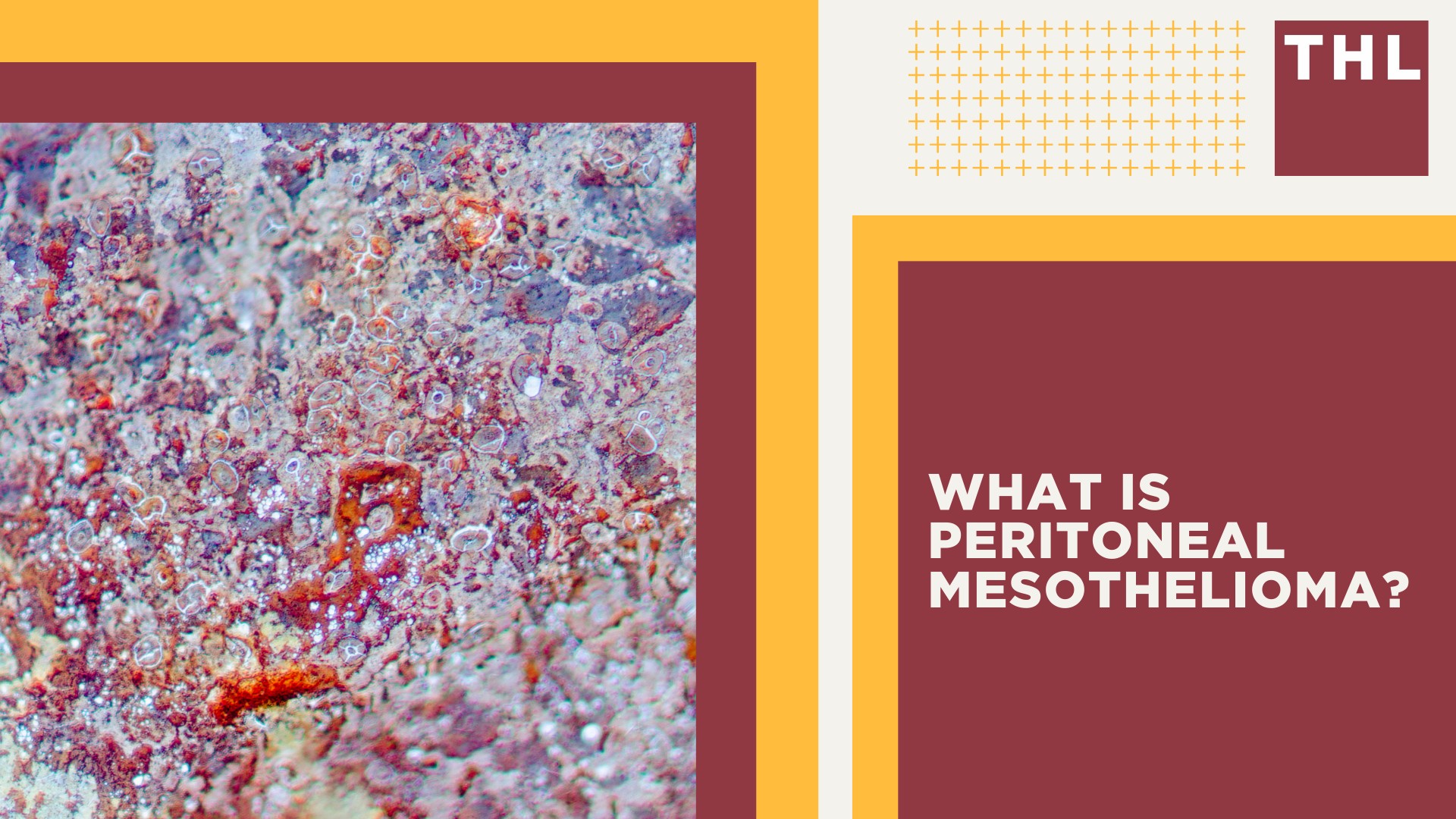 What Is Peritoneal Mesothelioma