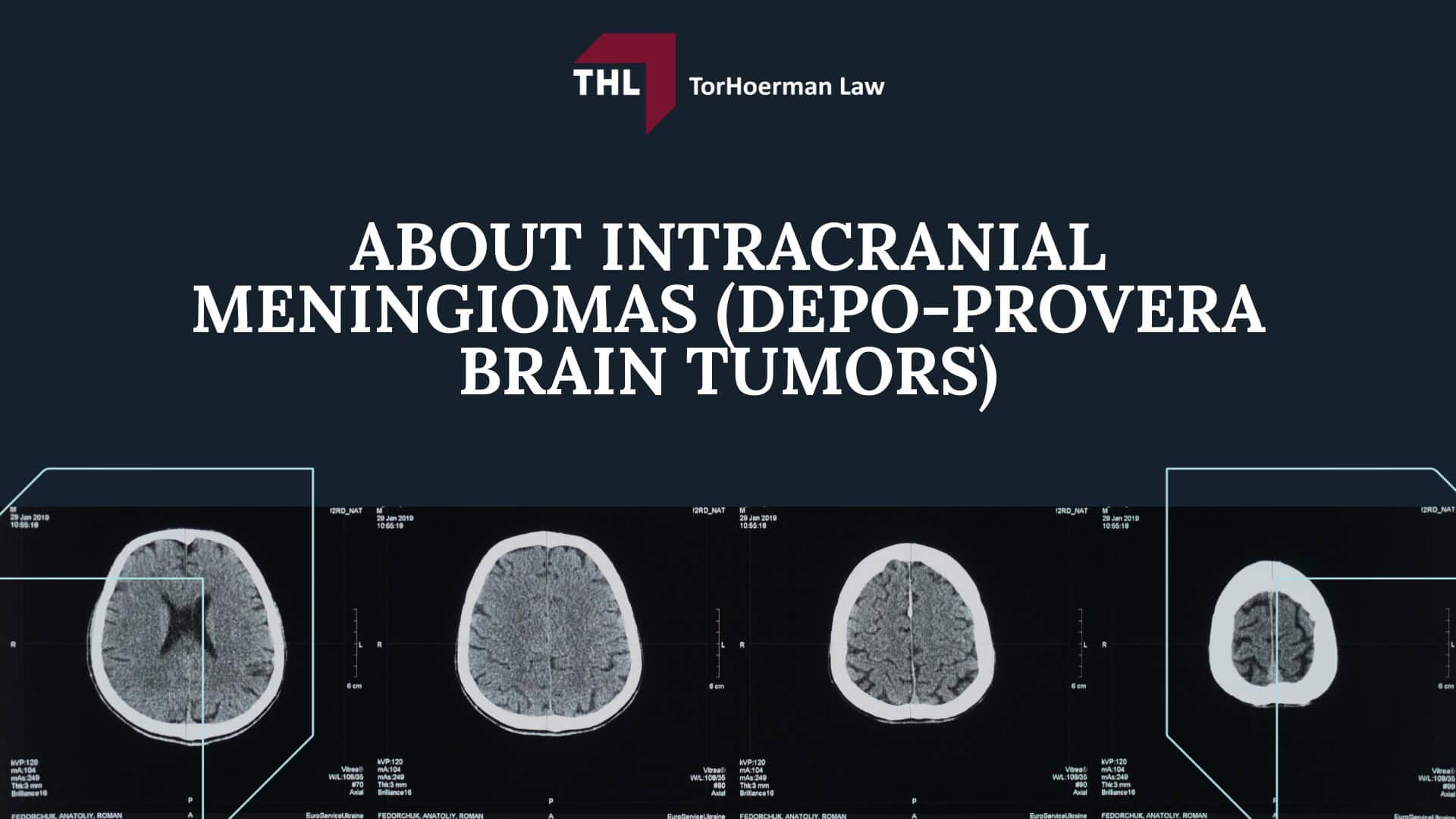 Depo-Provera Users Who Developed Brain Tumors are Filing Lawsuits; Who Exactly May Qualify for the Depo-Provera Lawsuit?; Use of Depo-Provera Injections Linked to Brain Tumors; About Intracranial Meningiomas (Depo-Provera Brain Tumors)