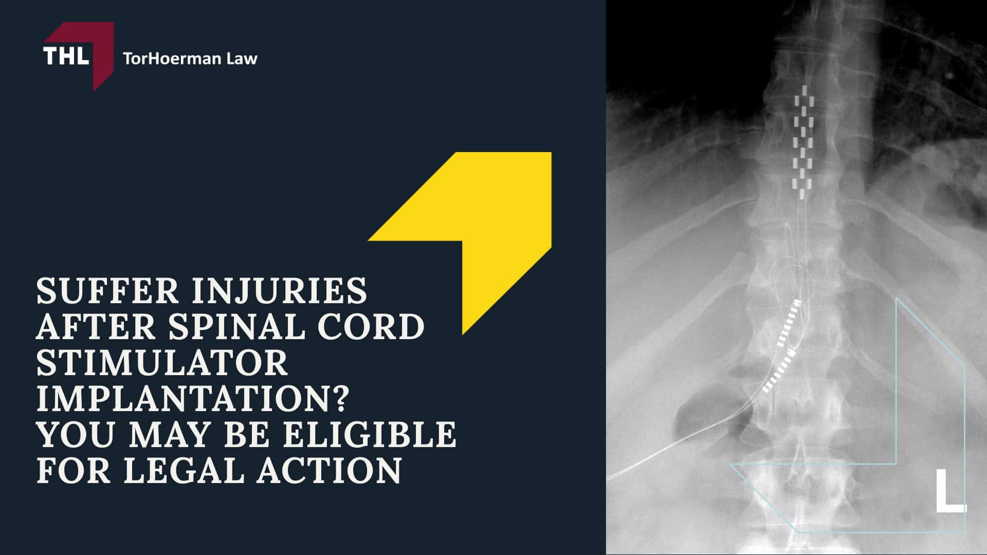 Suffer Injuries After Spinal Cord Stimulator Implantation? You May Be Eligible for Legal Action