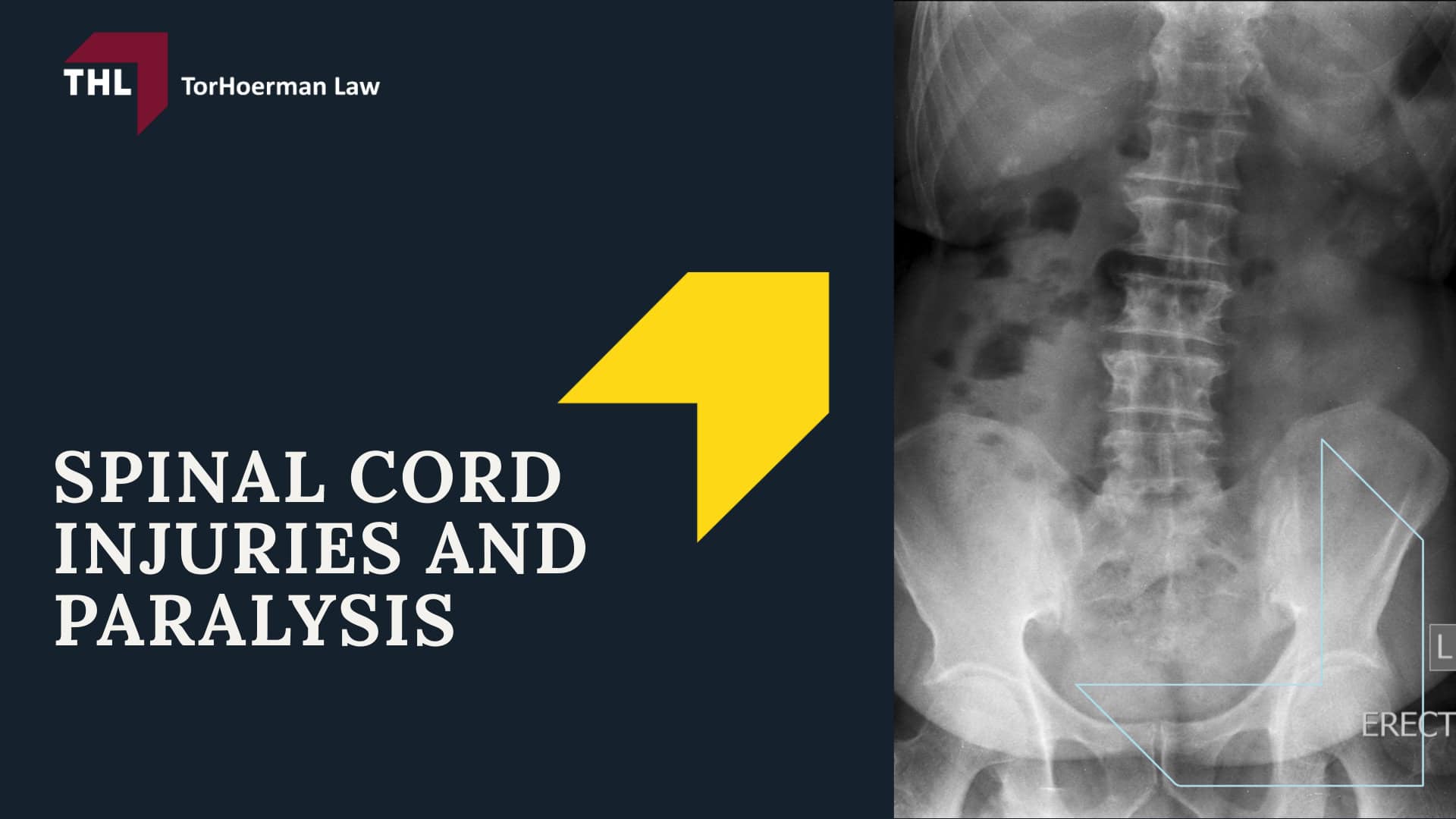 Common Truck Accident Injuries - Common Truck Accident Injuries - torhoerman law; Common Truck Accident Injuries - Common Truck Accident Scenarios That Cause Serious Injury - torhoerman law; Common Truck Accident Injuries - Traumatic Brain Injuries (TBI) Caused by Truck Accidents - torhoerman law; Common Truck Accident Injuries - Spinal Cord Injuries and Paralysis - torhoerman law